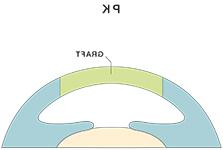穿透性角膜移植术（PK）