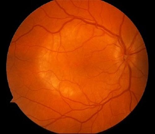 An image showing ocular syphilis, a group of inflammatory diseases in eye tissues infected by the bacteria that causes syphilis.