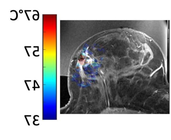 Contrast enhanced T1-weighted image of the breast with the temperature map overlaid.